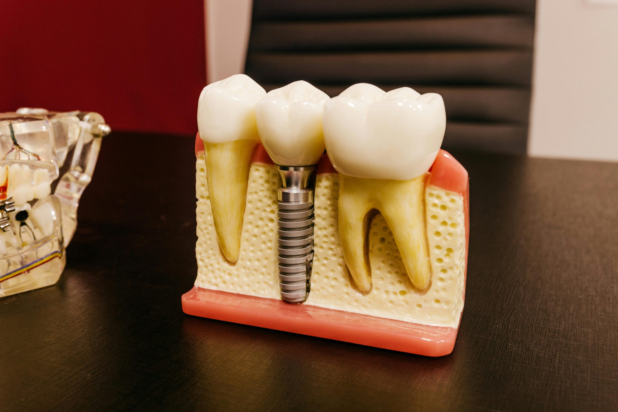 dental implants worth it Houston ceramic implant model showing tooth replacement