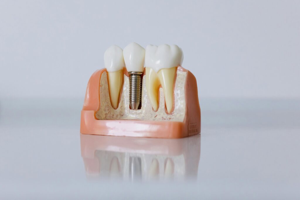dental implants worth it Houston model showing implant structure