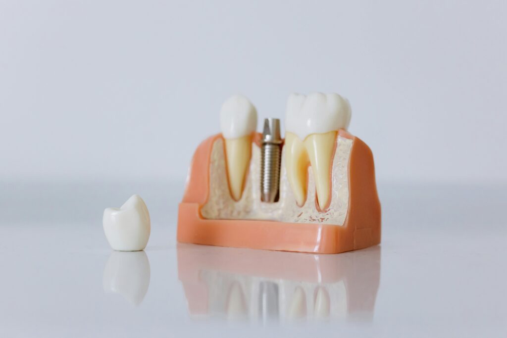 Dental implant lifespan illustrated with a dental implant model